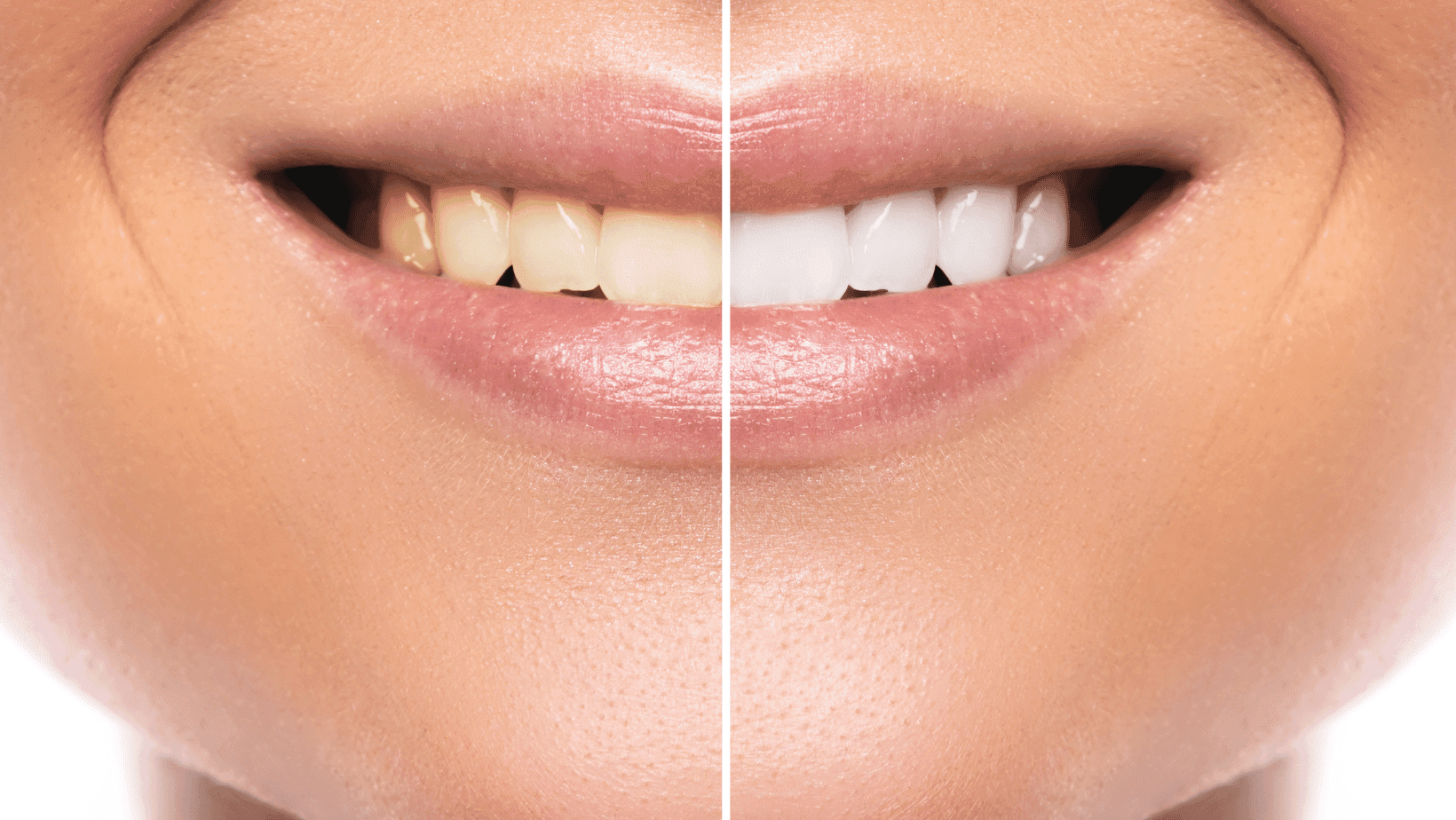 Teeth Whitening Options: Which One Is Right for You?